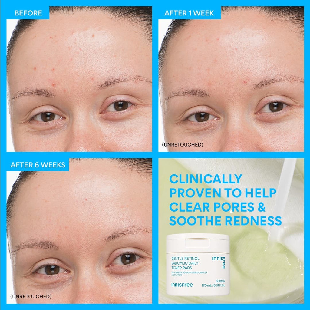 Daily Gentle Retinol Salicylic Toner Pads before and after