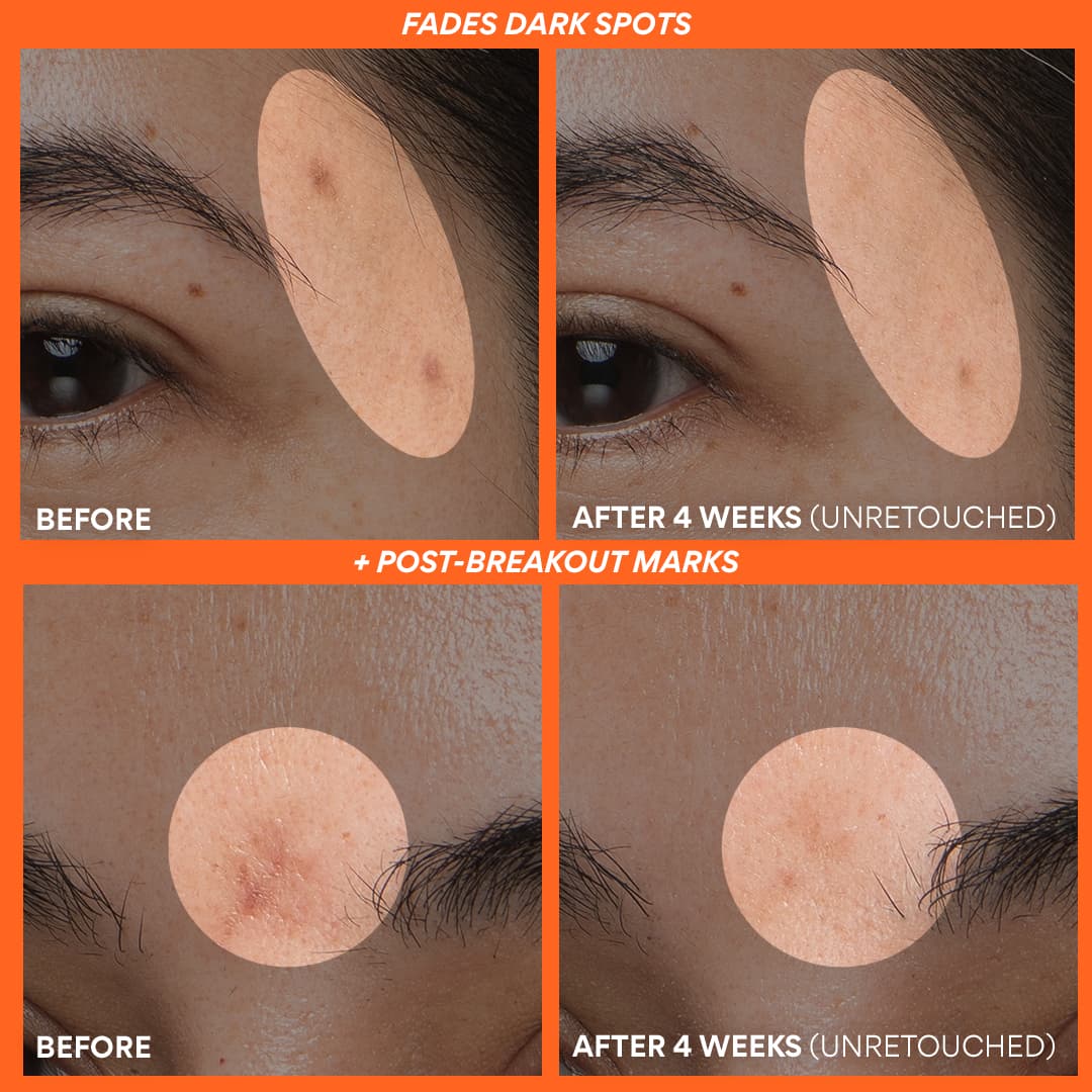 Vitamin C Serum before and after 4 weeks